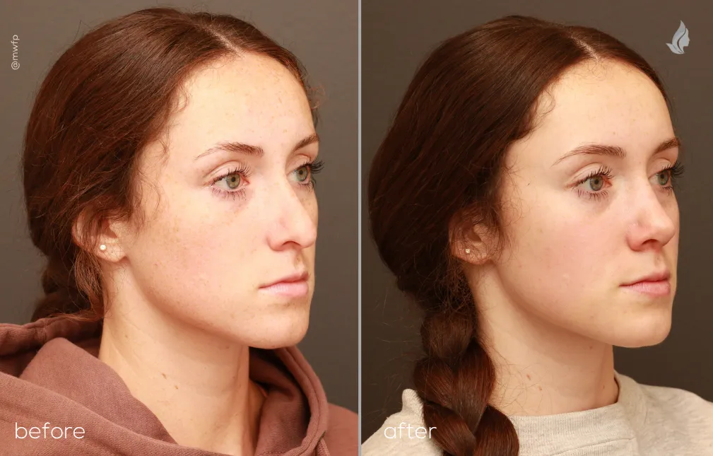 Right Oblique View rhinoplasty before and after photo by Dr. Bakeman