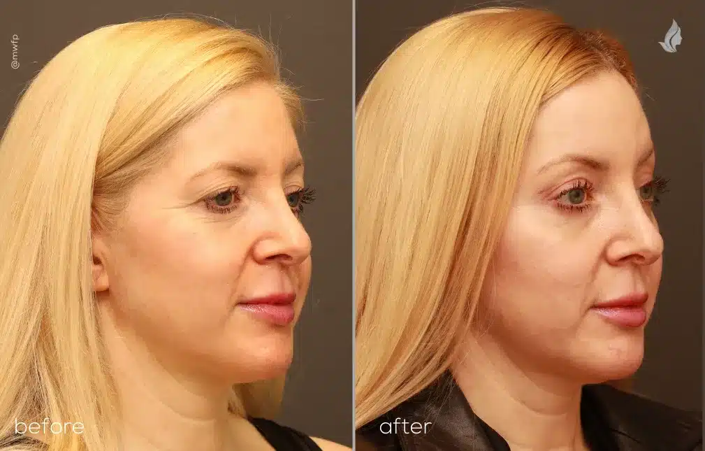 Right Oblique View upper blepharoplasty and endoscopic browlift before and after by Dr. Farhood