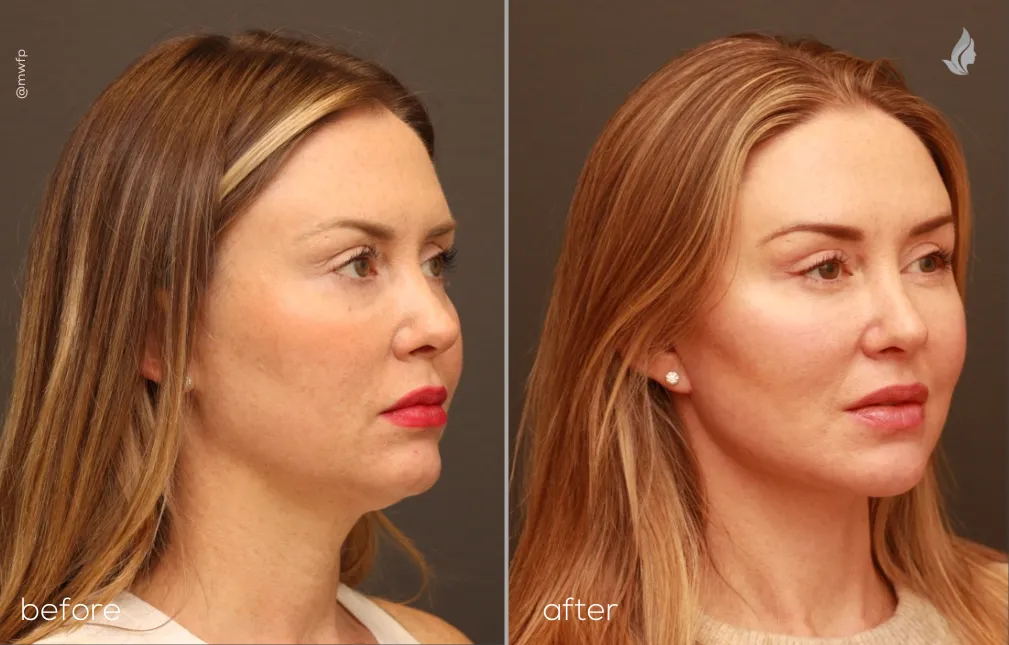 Right Oblique lower facelift upper blepharoplasty and small chin implant by Dr Griffin