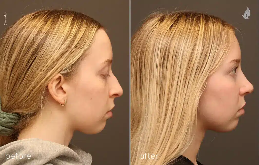 Right Profile Front View autologous fat grafting & rhinoplasty before and after photo by Dr. Griffin