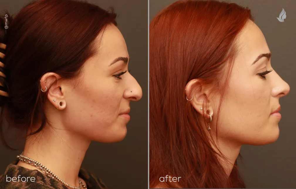 Right Profile View Cosmetic and functional Rhinoplasty before and after by Dr. Griffin