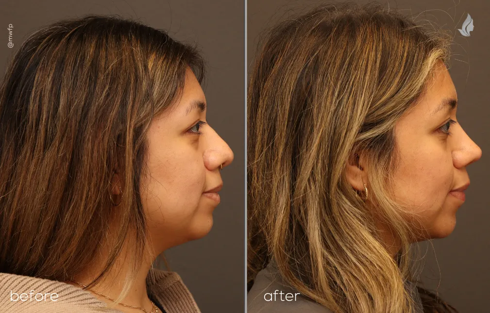 Right Profile View before and after Rhinoplasty & Lower blepharoplasty by Dr. Farhood