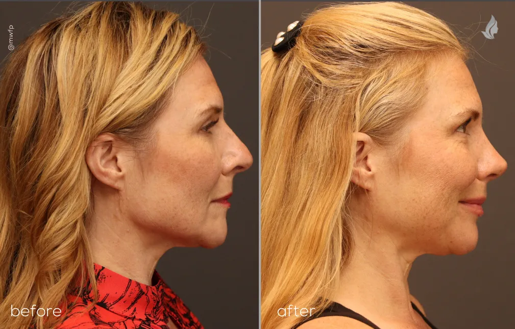 Right Profile View rhinoplasty before and after photo by Dr. Bakeman