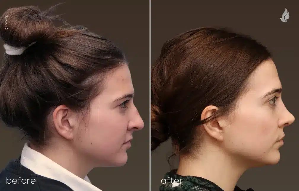 Right Profile View rhinoplasty before and after by Dr. Tolan