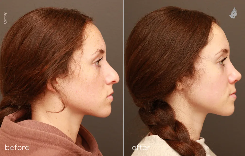Right SIde View rhinoplasty before and after photo by Dr. Bakeman