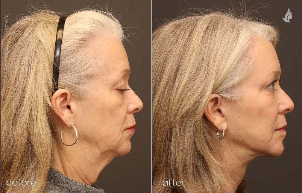 Right Side View before and after Facelift, temporal brow lift, bilateral upper eyelid by Dr. Tolan