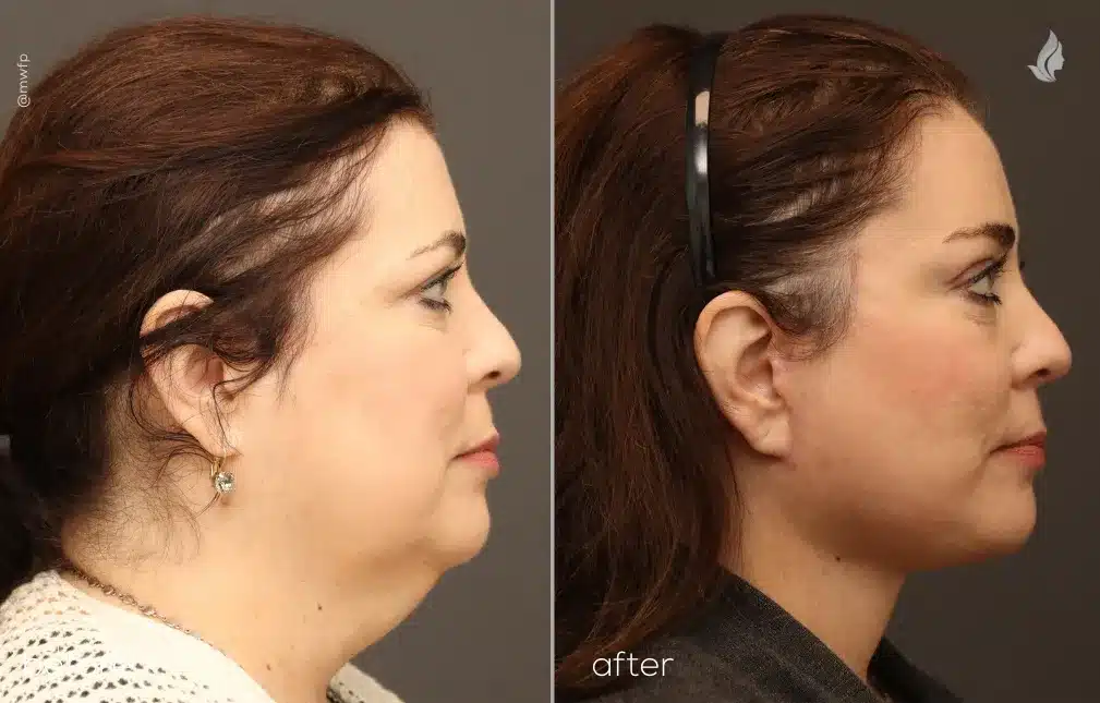 Right Side View deep plane face lift and neck lift before and after by Dr. Farhood