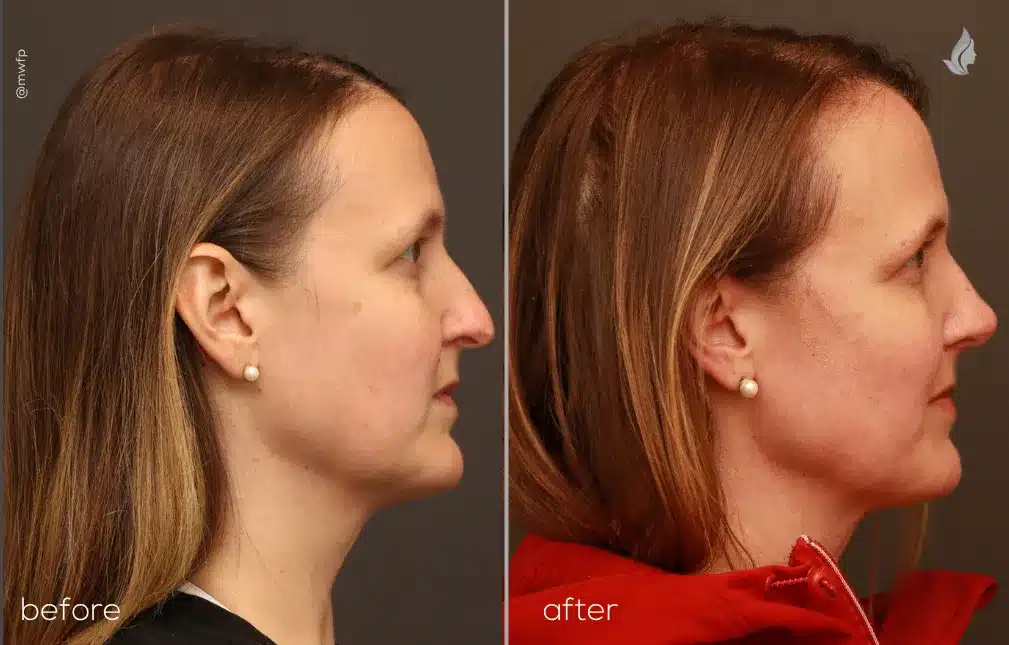 Right Side View rhinoplasty before and after by Dr. Griffin