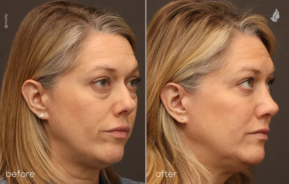 Right oblique View Blepharoplasty and Rhinoplasty before and after by Dr. Bakeman