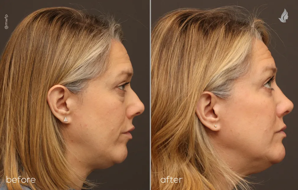 Right profile View Blepharoplasty and Rhinoplasty before and after by Dr. Bakeman