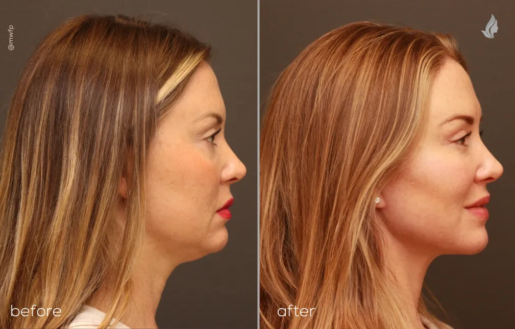 Right Profile lower facelift, upper blepharoplasty and small chin implant by Dr. Griffin