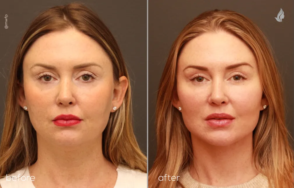 front view lower facelift upper blepharoplasty and small chin implant by Dr Griffin