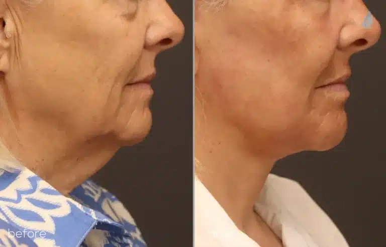 right side deep plane facelift combined with a structural neck lift