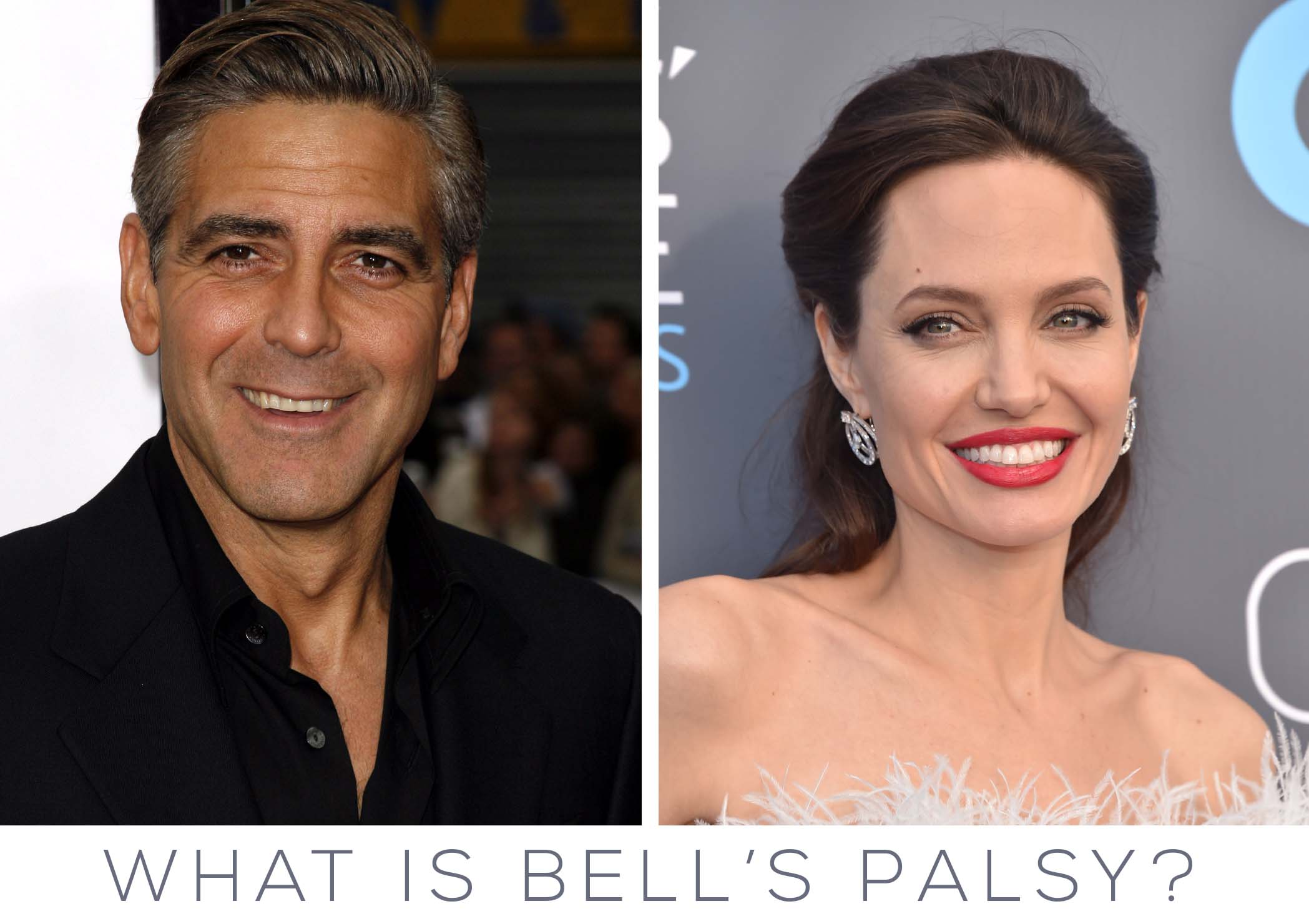 Hollywood stars that had Bells Palsy
