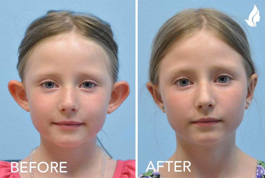 Otoplasty actual patient before and after photo by Midwest Facial Plastic Surgery