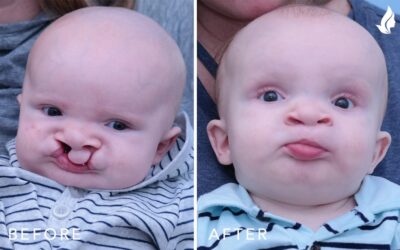 Restoring Smiles with Cleft Lip & Palate Repair