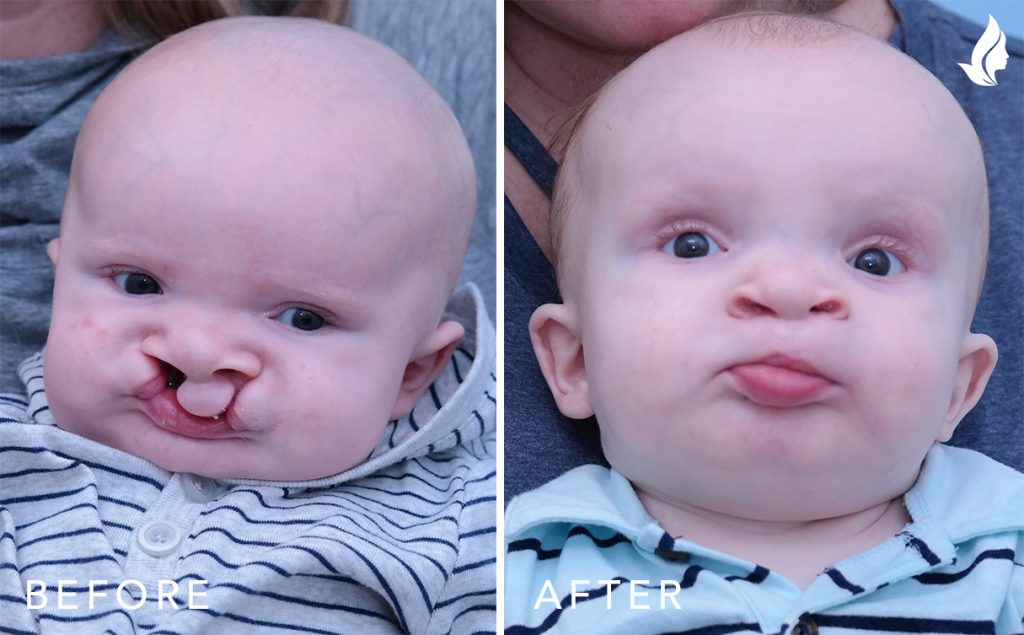 Baby with cleft before and after