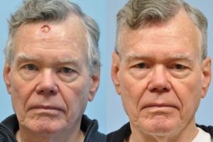 Mohs Reconstruction before and after photo by Midwest Facial Plastic Surgery in Minnesota