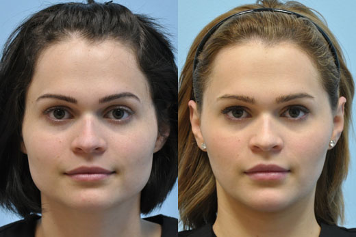 Injectable Fillers before and after photo by Midwest Facial Plastic Surgery in Minnesota