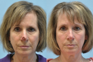 Mohs Reconstruction before and after photo by Midwest Facial Plastic Surgery in Minnesota