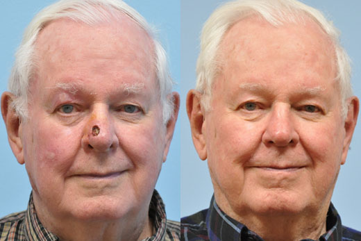 Mohs Reconstruction before and after photo by Midwest Facial Plastic Surgery in Minnesota