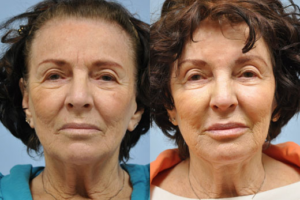 Injectable Fillers before and after photo by Midwest Facial Plastic Surgery in Minnesota