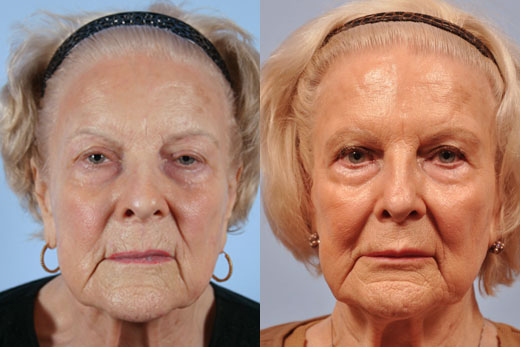 Injectable Fillers before and after photo by Midwest Facial Plastic Surgery in Minnesota