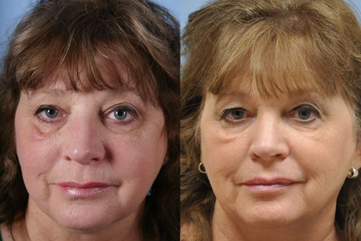 Injectable Fillers before and after photo by Midwest Facial Plastic Surgery in Minnesota