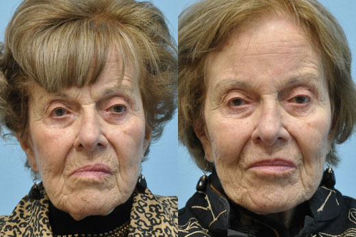 Injectable Fillers before and after photo by Midwest Facial Plastic Surgery in Minnesota