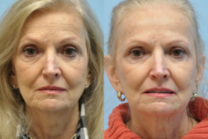 Injectable Fillers before and after photo by Midwest Facial Plastic Surgery in Minnesota