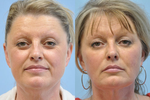 Injectable Fillers before and after photo by Midwest Facial Plastic Surgery in Minnesota