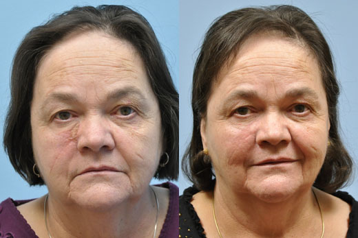 Laser Skin Resurfacing before and after photo by Midwest Facial Plastic Surgery in Minnesota