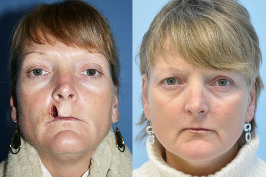Lip Augmentation before and after photo by Midwest Facial Plastic Surgery in Minnesota