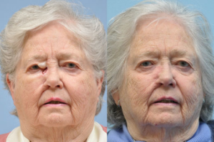 Mohs Reconstruction before and after photo by Midwest Facial Plastic Surgery in Minnesota