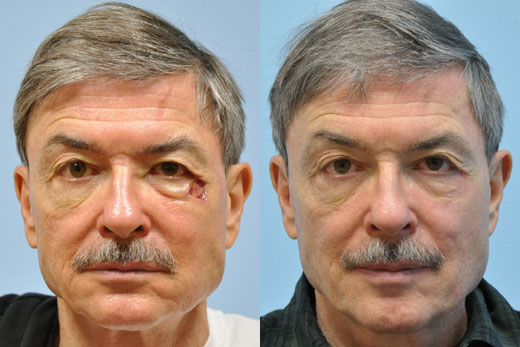 Mohs Reconstruction before and after photo by Midwest Facial Plastic Surgery in Minnesota