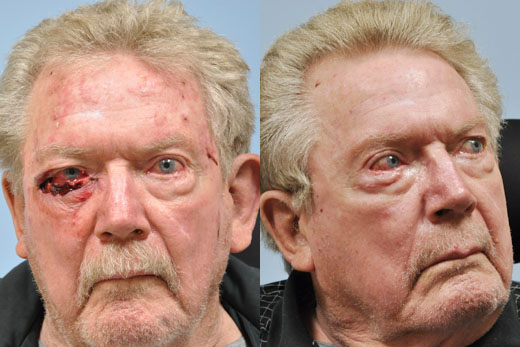 Mohs Reconstruction before and after photo by Midwest Facial Plastic Surgery in Minnesota