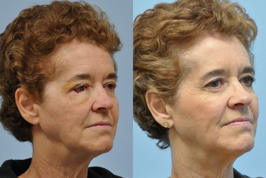 Mohs Reconstruction before and after photo by Midwest Facial Plastic Surgery in Minnesota