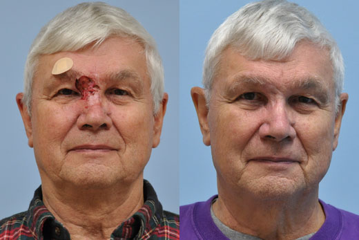 Mohs Reconstruction before and after photo by Midwest Facial Plastic Surgery in Minnesota