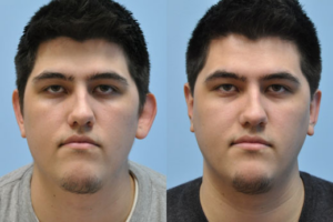 Otoplasty (Ear Reconstruction) before and after photo by Midwest Facial Plastic Surgery in Minnesota