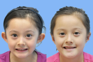 Otoplasty (Ear Reconstruction) before and after photo by Midwest Facial Plastic Surgery in Minnesota