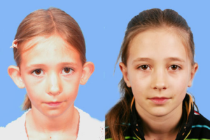 Otoplasty (Ear Reconstruction) before and after photo by Midwest Facial Plastic Surgery in Minnesota