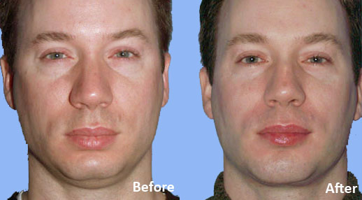 Facial Implants Chin Augmentation before and after photo by Midwest Facial Plastic Surgery in Minnesota