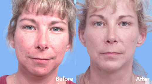 Facial Implants Chin Augmentation before and after photo by Midwest Facial Plastic Surgery in Minnesota