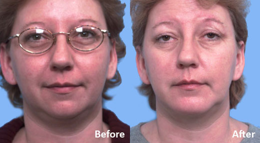 Facial Implants Chin Augmentation before and after photo by Midwest Facial Plastic Surgery in Minnesota