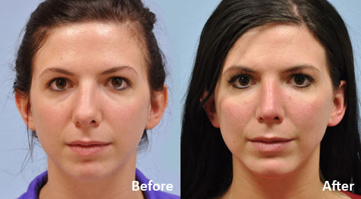 Facial Implants Chin Augmentation before and after photo by Midwest Facial Plastic Surgery in Minnesota