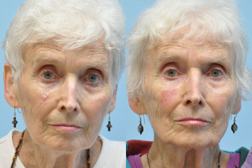 Laser Skin Resurfacing before and after photo by Midwest Facial Plastic Surgery in Minnesota