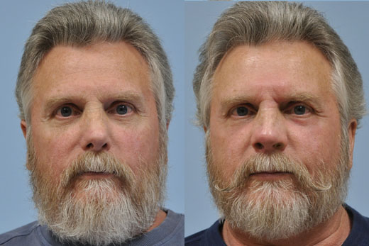 Laser Skin Resurfacing before and after photo by Midwest Facial Plastic Surgery in Minnesota