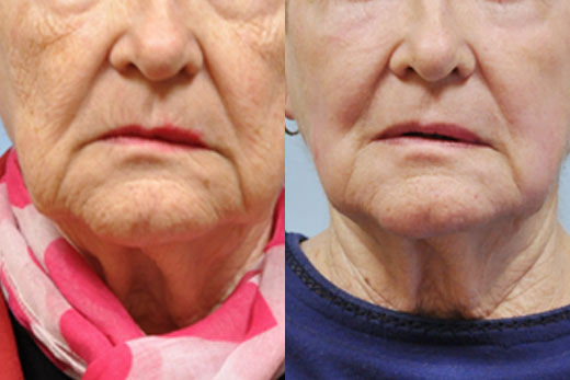 Laser Skin Resurfacing before and after photo by Midwest Facial Plastic Surgery in Minnesota