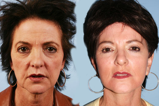 Laser Skin Resurfacing before and after photo by Midwest Facial Plastic Surgery in Minnesota