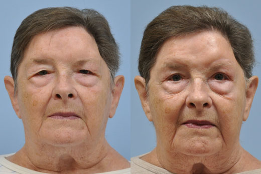 Eyelid Surgery before and after photo by Midwest Facial Plastic Surgery in Minnesota